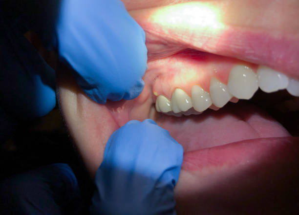 Best Emergency Tooth Extraction  in Utqiagvik, AK